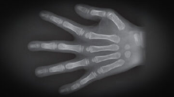 X-ray of hand